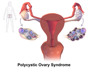 How to deal with Hair Growth from Pcos