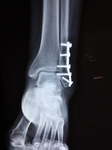 When You May Want To Consider Custom Orthotics