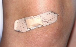 The Common Spider Veins Myths
